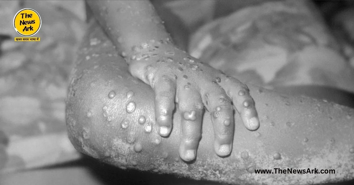 Monkeypox (mpox) virus